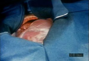 Listen to an exposed human heartbeat during open-heart surgery