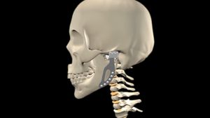 Know about prosthetic jaw joint replacement and how that technology can help in other joint replacements like the shoulder, the hip, or even the spine